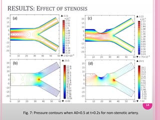 Computational simulation of blood flow in stenosed Arterial Bifurcation ...