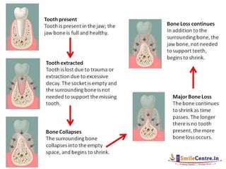 alveolar ridge expansion and socket preservation | PPT