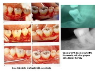 alveolar ridge expansion and socket preservation | PPT