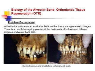 alveolar ridge expansion and socket preservation | PPT