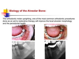 alveolar ridge expansion and socket preservation | PPT