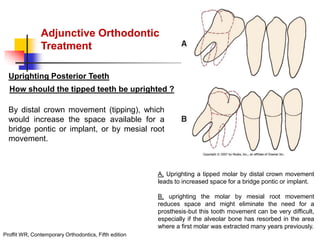 alveolar ridge expansion and socket preservation | PPT