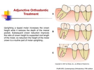 alveolar ridge expansion and socket preservation | PPT