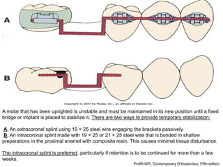 alveolar ridge expansion and socket preservation | PPT