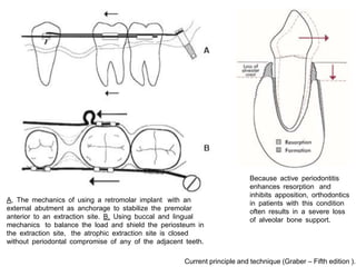 alveolar ridge expansion and socket preservation | PPT