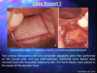 alveolar ridge expansion and socket preservation | PPT