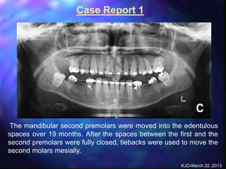 alveolar ridge expansion and socket preservation | PPT