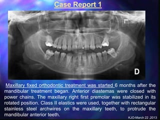 alveolar ridge expansion and socket preservation | PPT
