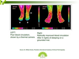 Source: Dr. William Amalu, President, International Academy of Clinical Thermography LEFT: Poor blood circulation, shown b...