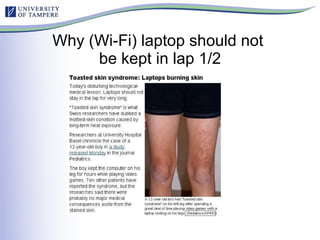 Why (Wi-Fi) laptop should not  be kept in lap 1/2 