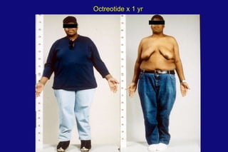 Octreotide x 1 yr 