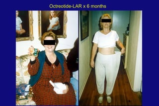 Octreotide-LAR x 6 months 