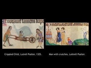 Crippled Child, Lutrell Psalter, 1325. Man with crutches, Luttrell Psalter.
 