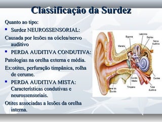 Classificação da Surdez
Quanto ao tipo:
 Surdez NEUROSSENSORIAL:

Causada por lesões na cóclea/nervo
  auditivo
 PERDA AUDITIVA CONDUTIVA:

Patologias na orelha externa e média.
Ex:otites, perfuração timpânica, rolha
  de cerume.
 PERDA AUDITIVA MISTA:

  Características condutivas e
  neurossensoriais.
Otites associadas a lesões da orelha
  interna.
 