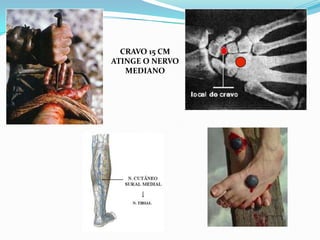 CRAVO 15 CM
ATINGE O NERVO
   MEDIANO
 