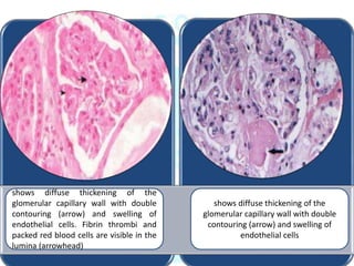 shows diffuse thickening of the
glomerular capillary wall with double
contouring (arrow) and swelling of
endothelial cells. Fibrin thrombi and
packed red blood cells are visible in the
lumina (arrowhead)
shows diffuse thickening of the
glomerular capillary wall with double
contouring (arrow) and swelling of
endothelial cells
 