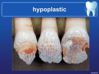 hypoplastic
 