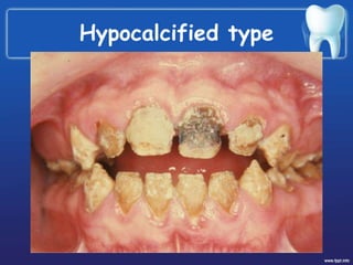 Hypocalcified type
 