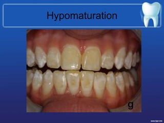 Hypomaturation
 