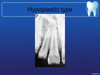 Hypoplastic type
 