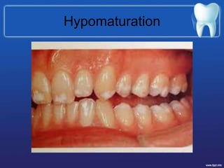 Hypomaturation
 