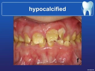 hypocalcified
 