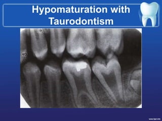 Hypomaturation with
Taurodontism
 