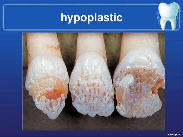 hypoplastic 13
