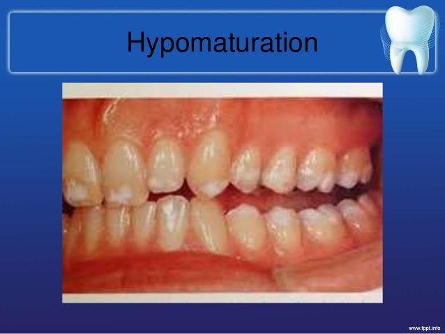 hypomaturation 24 hypocalcified 25