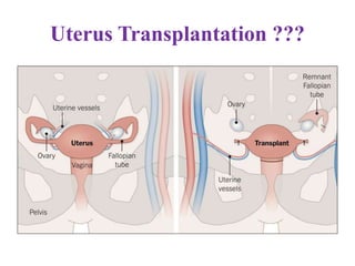 Uterus Transplantation ???
 