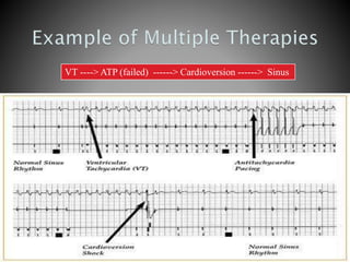 VT ----> ATP (failed) ------> Cardioversion ------> Sinus
 