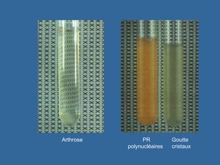 Arthrose  PR  Goutte polynucléaires cristaux 