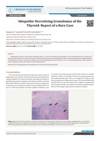 Idiopathic Necrotizing Granulomas of the
Thyroid: Report of a Rare Case
Case presentation
A 75 year old male presented to his physician with 6 months of
fatigue, poor concentration, cold intolerance, generalized weakness
and gait imbalance. He denied neck pain, preceding viral illness or
hyperthyroidsymptoms.Palpationrevealedanon-tenderstonyhard
thyroid. His TSH was 153mIU/L (reference 0.3-4.2) as compared to
a normal level 6 months prior; and free T4 was 0.3ng/dL (reference
0.9-1.7). Thyroid peroxidase and thyro globulin antibodies were
not elevated. He underwent partial left lobe resection at another
institution which on histology showed necrotizing granulomas
with multinucleated giant cells on a background of fibrosis and
chronic lymphocytic inflammation (Figure 1A). QuantiFERON Gold
and PPD skin tests for Tuberculosis were negative. Levothyroxine
100 micrograms daily was initiated for primary hypothyroidism,
however the etiology of granulomas remained a mystery.
Case Report
Advancements in Case Studies
C CRIMSON PUBLISHERS
Wings to the Research
1/3Copyright © All rights are reserved by Vahab Fatourechi.
Volume 1 - Issue - 2
Anupam K1, 2
, Jason DE2
, Diva RS3
and Vahab F1, 2
*
1
Division of Endocrinology, Diabetes, Metabolism, and Nutrition, Mayo Clinic, USA
2
Department of Medicine, Mayo Clinic, Rochester, USA
3
Department of Laboratory Medicine and Pathology, Mayo Clinic, Rochester, USA
*Corresponding author: Vahab Fatourechi, MD, Professor of Medicine, Division of Endocrinology, Diabetes, Metabolism, and Nutrition, Department of
Medicine, Mayo Clinic, 200 First Street SW, Rochester, New York, USA, MN 55905
Submission: February 14, 2018; Published: May 18, 2018
Abstract
Granulomatous disease of the thyroid commonly presents as sub acute (De Quervain) thyroiditis [1]. Necrotizing granulomas in thyroid have
been reported with infection (tuberculous [2] and fungal [3]), granulomatosis with polyangiitis [4], plasma cell granuloma[5], post-surgical/palpation
thyroiditis [6] and rarely in sarcoidosis (usually causes non-necrotizing granulomas). We present a case of necrotizing granulomas within thyroid of
unclear etiology associated with sudden profound hypothyroidism.
Keywords: Necrotizing granulomas; Hypothyroidism; Tuberculosis; Subacute thyroiditis
Figure 1A: Partial left thyroid lobe resection histology with hematoxylin and eosin stain original magnification x 40 showing
complete effacement of thyroid parenchyma by the presence of background fibrosis and chronic lymphocytic inflammation.
Necrotizing granulomas (black arrows) and a few multinucleated giant cells (red arrow) are observed.
ISSN 2639-0531
 