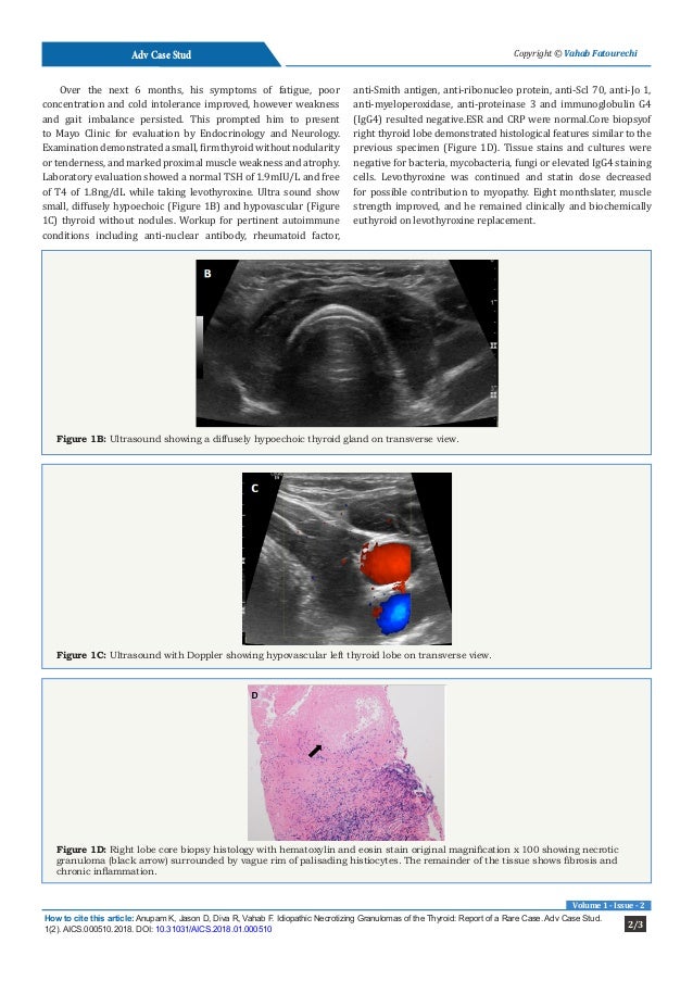 Idiopathic Necrotizing Granulomas of the Thyroid Report of a Rare Ca…