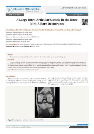 A Large Intra-Articular Ossicle in the Knee
Joint-A Rare Occurrence
Introduction
Meniscal ossicles are uncommon, often incidental, findings
on radiography and cross-sectional imaging of the knee [1,2]. The
aetiology of a meniscal ossicle has not been definitively established,
and congenital, traumatic, and degenerative origins have been
suggested [2-4]. Its association with the posterior horn of the
medial meniscus may favour a traumatic origin. Its occurrence with
ACL suggests more a congenital origin [5].
Case Report
Advancements in Case Studies
C CRIMSON PUBLISHERS
Wings to the Research
1/4Copyright © All rights are reserved by Lokesh Rana.
Volume - 1 Issue - 3
Lokesh Rana1
, Dinesh Sood2
, Raman Chauhan3
, Roshni Shukla4
, Pooja Gurnal SR5
and Himanshu Nautiyal3
1
Department of Radio-diagnosis, Dr RPGMC, India
2
Department of Radio-diagnosis, Dr RPGMC, India
3
Department of Preventive and social medicine, Dr RPGMC, India
4
Department of Radio-diagnosis, Dr RPGMC, India
5
Department of Anaesthesia, Dr RPGMC, India
*Corresponding author: Lokesh Rana, Senior Resident, Department of Radio-diagnosis, Dr RPGMC, Kangra at Tanda, Himachal Pradesh, India
Submission: March 16, 2018; Published: May 22, 2018
Abstract
The occurrence of an intra-articular ossicle is not rare in the knee but seldom have they achieved large size.
Case report
We report a 14-year-old male who underwent a magnetization resonance imaging of the right knee joint having history of pain in the right knee for
the past few months. There was no history of any trauma as such. On MR imaging we found a large intra articular ossicle in the knee joint in relation to
the anterior cruciate ligament causing lifting of the ACL anterior-laterally. Intra-articular accessory ossicle of knee is a rare occurrence which can grow
to size as seen in this case with significant mass effect and clinically mimic an ACL injury.
Keywords: Intraarticular ossicle; Anterior cruciate ligament
Figure 1: multiple intra-articular ossicles in coronal T1W.
ISSN 2639-0531
 