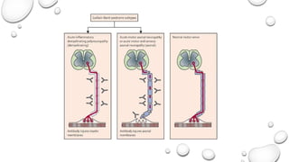 Comprehensive Overview of Acute Inflammatory Demyelinating ...