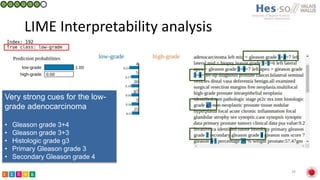 Classification of prostate cancer pathology reports using natural language processing