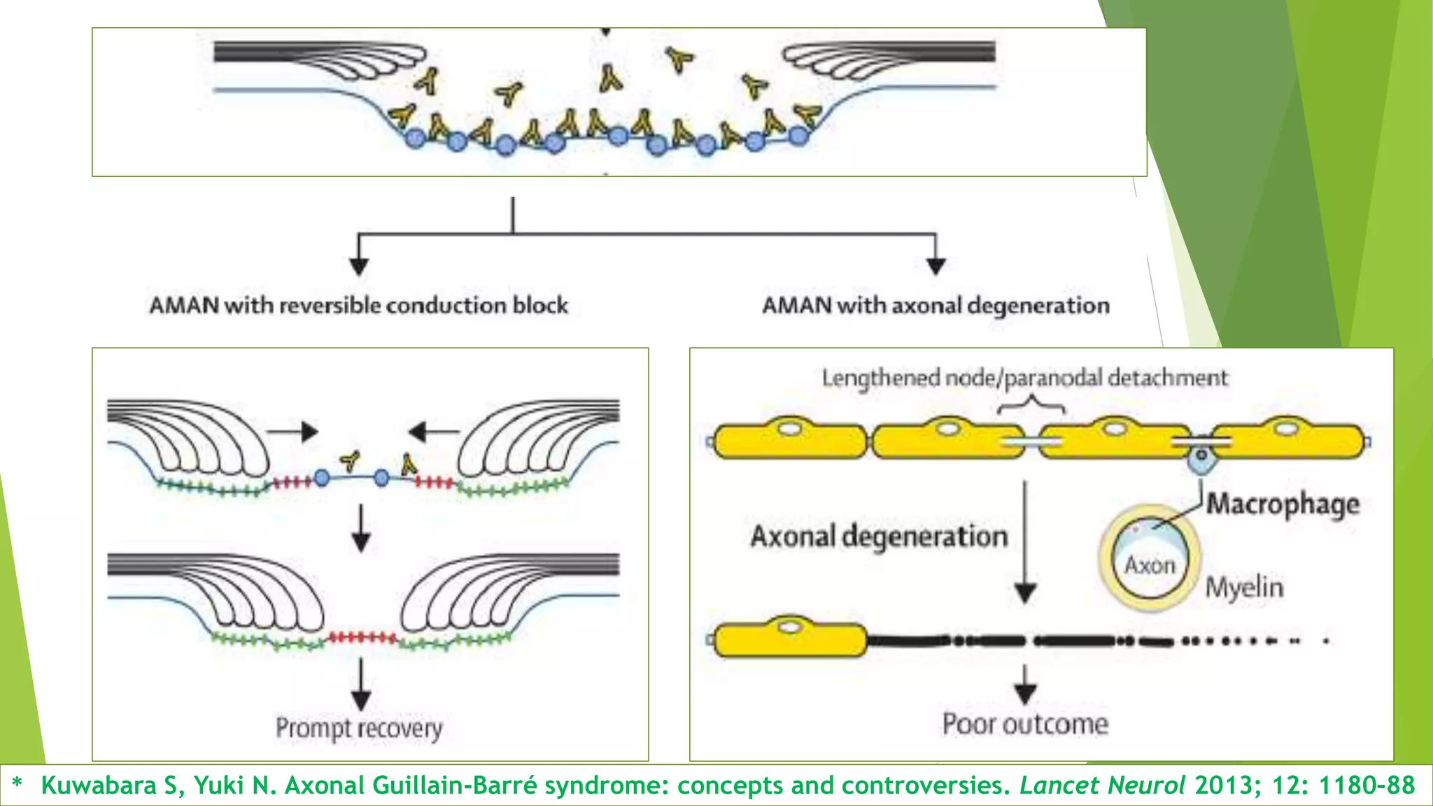 * Kuwabara S, Yuki N. Axonal Guillain-Barré syndrome: concepts and controversies. Lancet Neurol 2013; 12: 1180–88
 