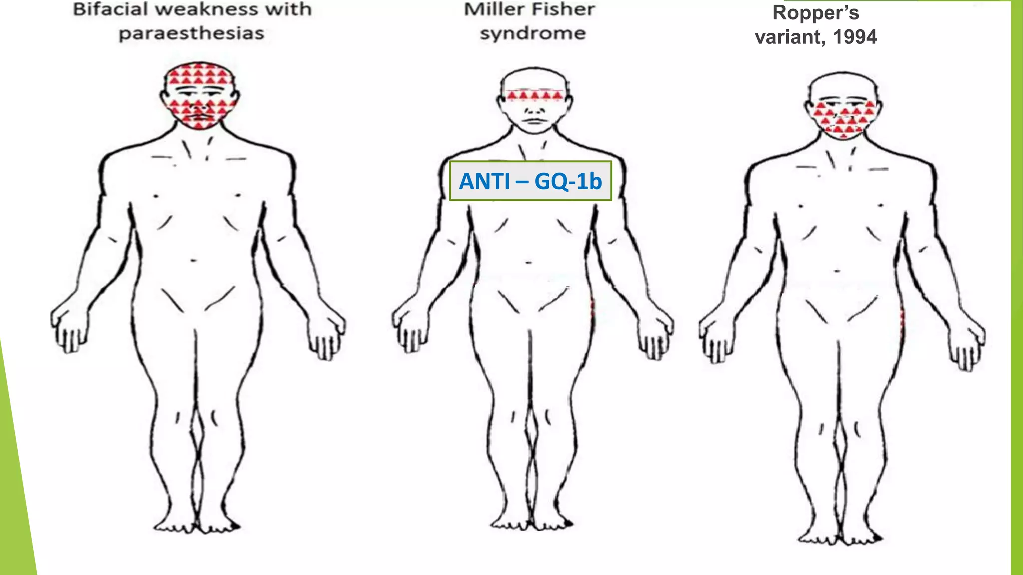 Variants
ANTI – GQ-1b
Ropper’s
variant, 1994
 