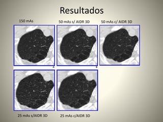 Resultados
150 mAs 50 mAs s/ AIDR 3D 50 mAs c/ AIDR 3D
25 mAs s/AIDR 3D 25 mAs c/AIDR 3D
 