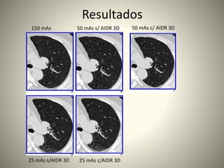 Resultados
150 mAs 50 mAs s/ AIDR 3D 50 mAs c/ AIDR 3D
25 mAs s/AIDR 3D 25 mAs c/AIDR 3D
 