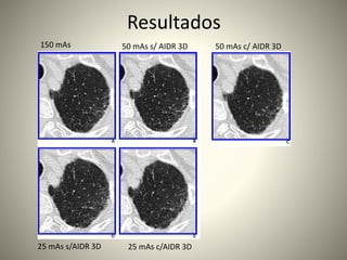 Resultados
150 mAs 50 mAs s/ AIDR 3D 50 mAs c/ AIDR 3D
25 mAs s/AIDR 3D 25 mAs c/AIDR 3D
 