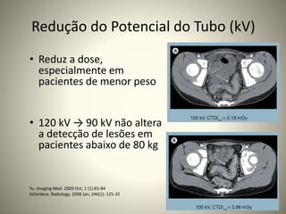 Redução do Potencial do Tubo (kV)
• Reduz a dose,
especialmente em
pacientes de menor peso
• 120 kV → 90 kV não altera
a detecção de lesões em
pacientes abaixo de 80 kg
Yu. Imaging Med. 2009 Oct; 1 (1):65-84
Schindera. Radiology. 2008 Jan; 246(1): 125-32
 