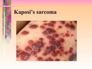 Kaposi’s sarcoma 
