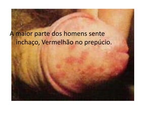 A maior parte dos homens sente inchaço, Vermelhão no prepúcio.
