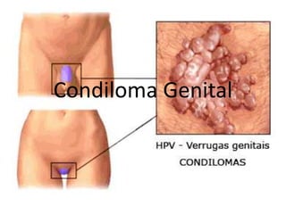 Condiloma Genital