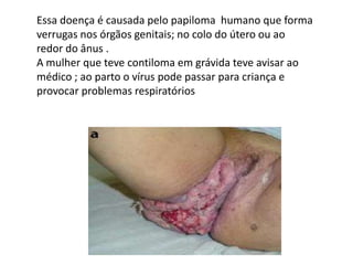 Essa doença é causada pelo papiloma  humano que forma  verrugas nos órgãos genitais; no colo do útero ou ao redor do ânus .A mulher que teve contiloma em grávida teve avisar ao médico ; ao parto o vírus pode passar para criança e provocar problemas respiratórios 