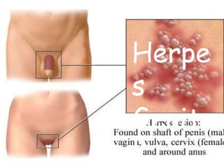 Herpes Genital