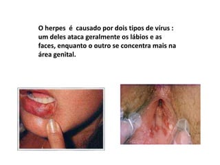O herpes  é  causado por dois tipos de vírus : um deles ataca geralmente os lábios e as faces, enquanto o outro se concentra mais na área genital. 