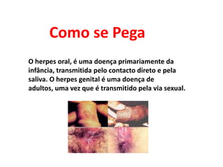 Como se PegaO herpes oral, é uma doença primariamente da infância, transmitida pelo contacto direto e pela saliva. O herpes genital é uma doença de adultos, uma vez que é transmitido pela via sexual.